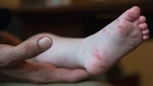 What to do for pain in hands and feet after fever, treatment for body pain after fever